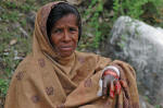 A leprosy victim